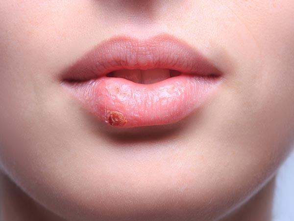 Manfaat laneige lip sleeping mask_menghilangkan bekas luka (Copy)