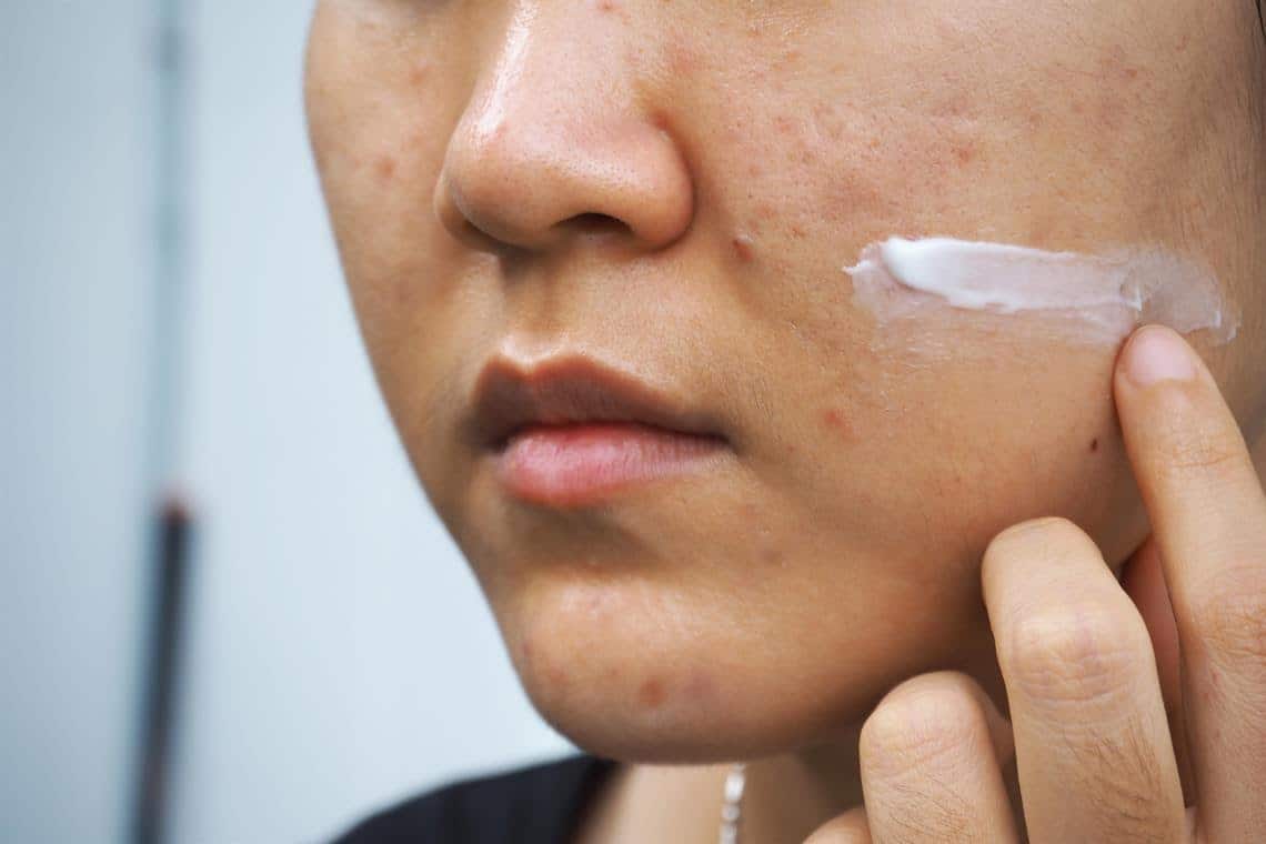 Manfaat Skincare yang Mengandung Retinol untuk Kulit Wajah 5