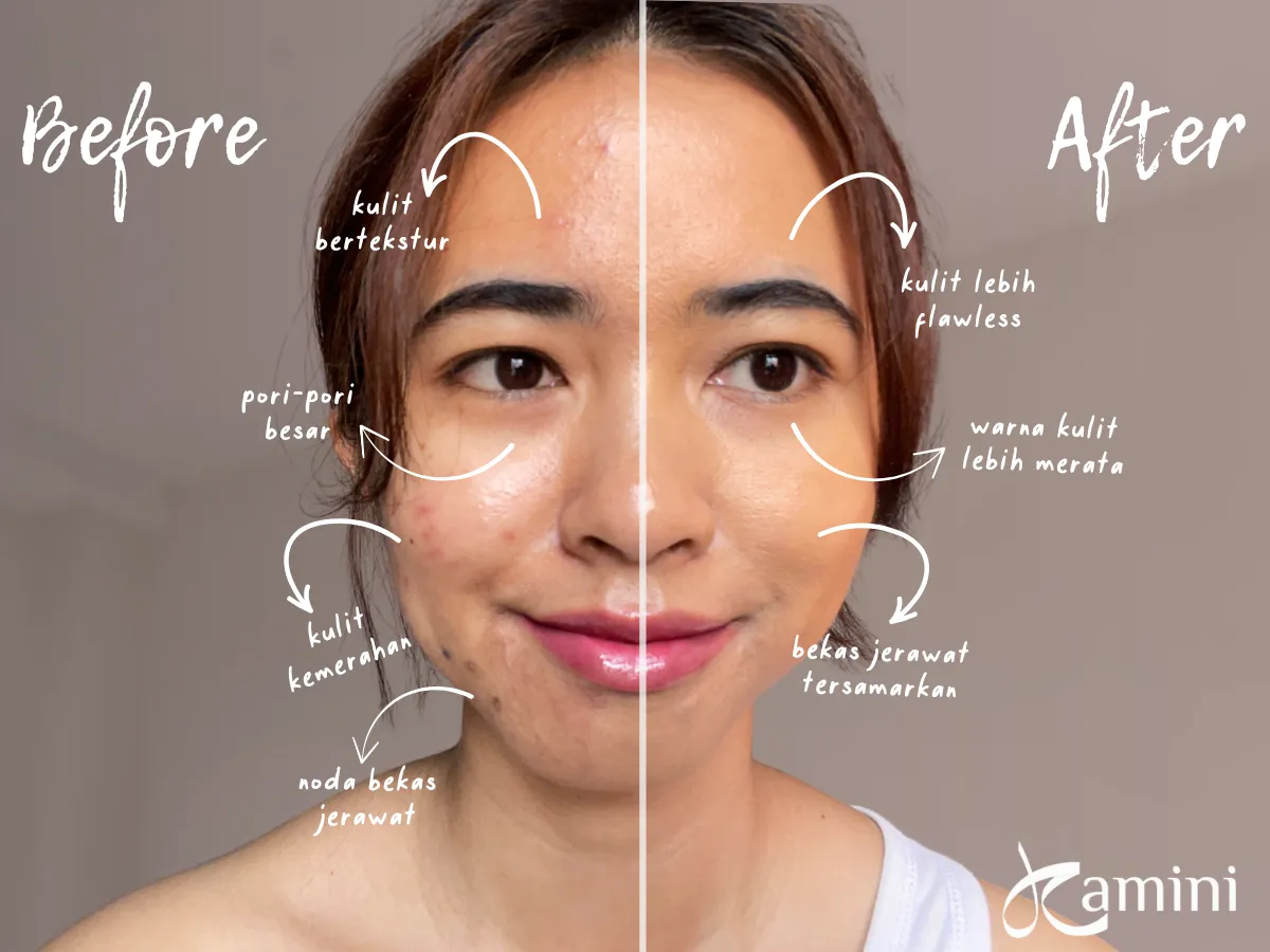 Acne-Prone dan Sensitive Skin Friendly_