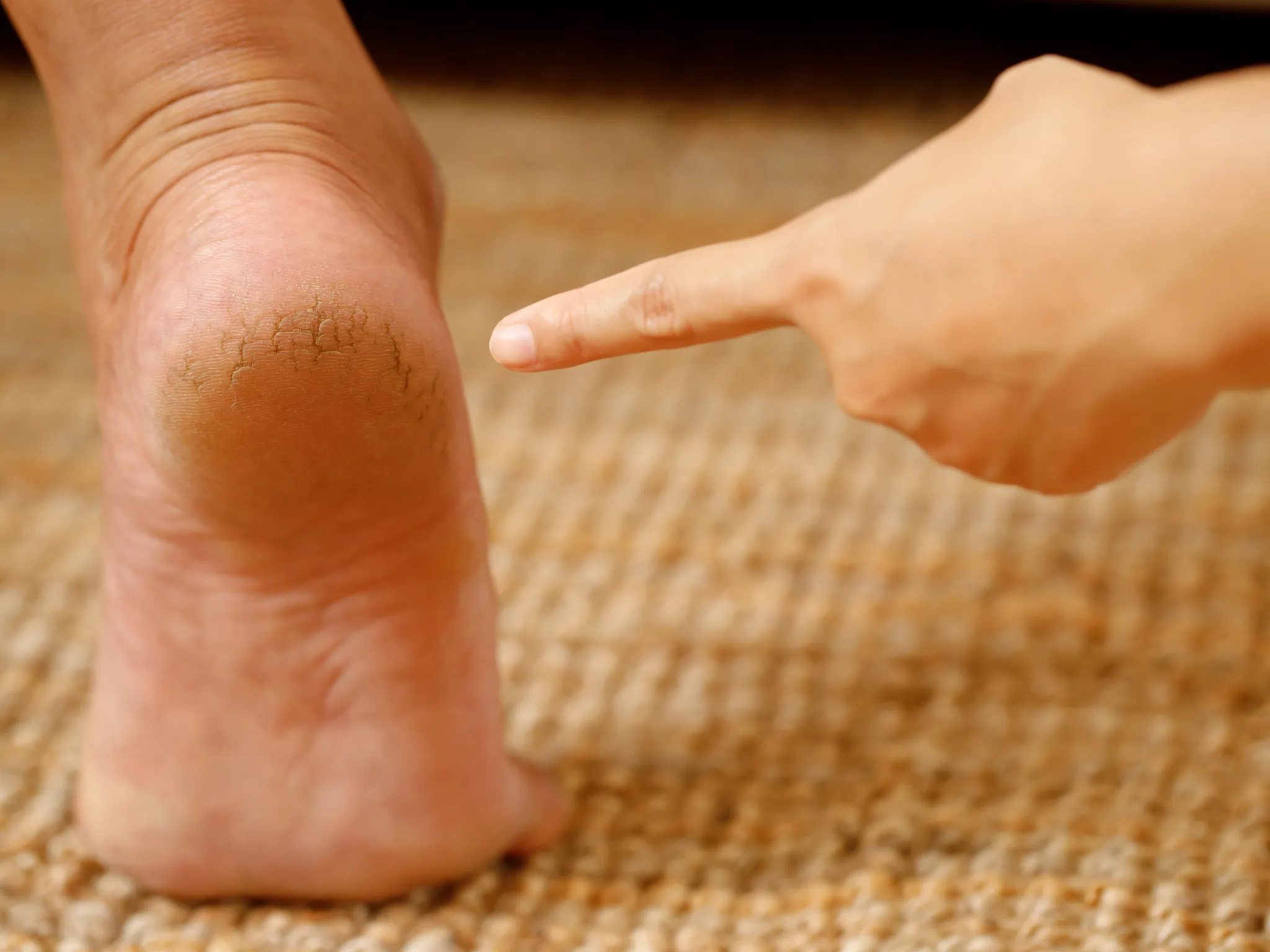 1. Kulit Kering yang Nggak Diperhatikan_