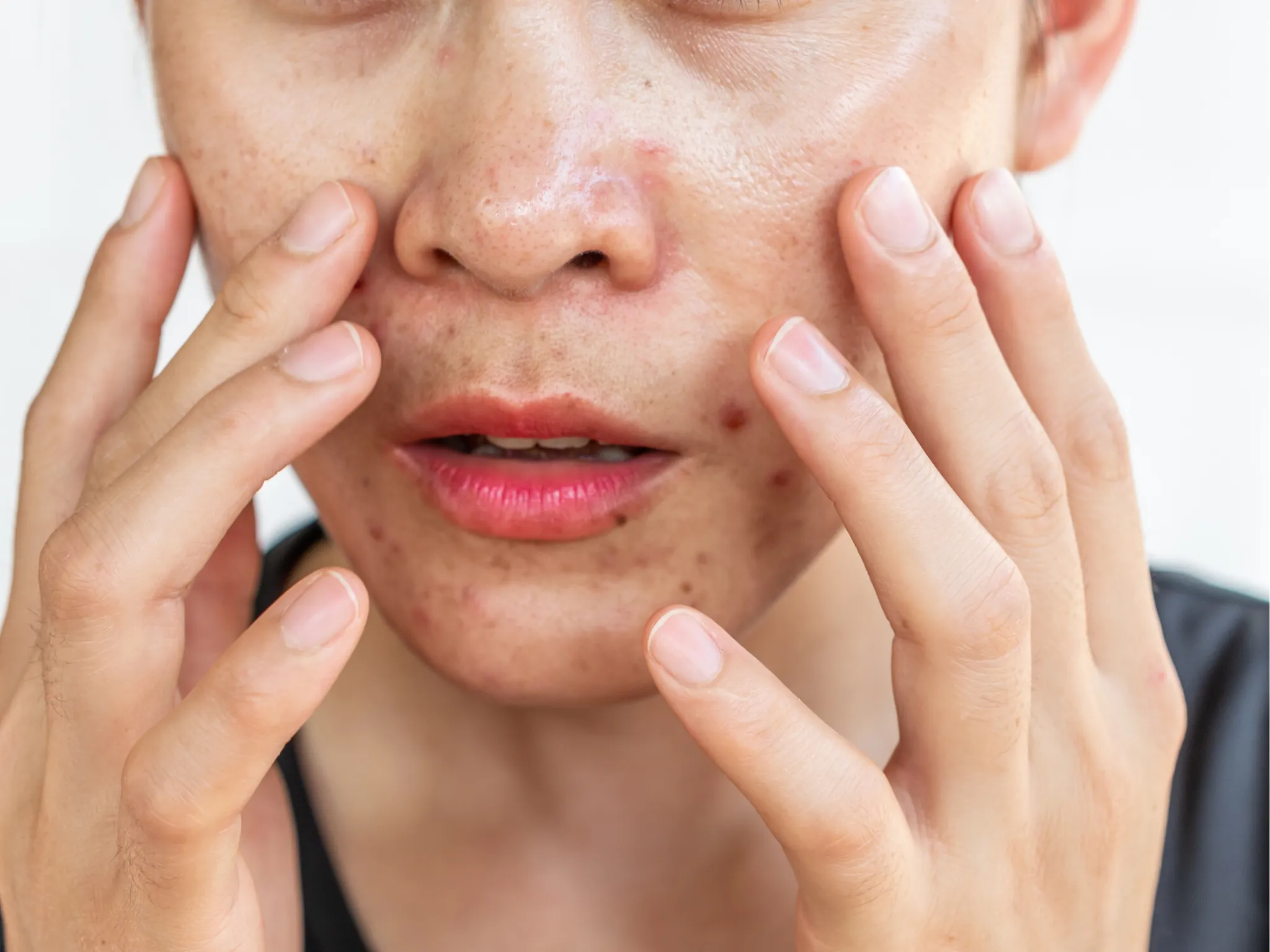 1. Minyak Berlebih di Wajah_