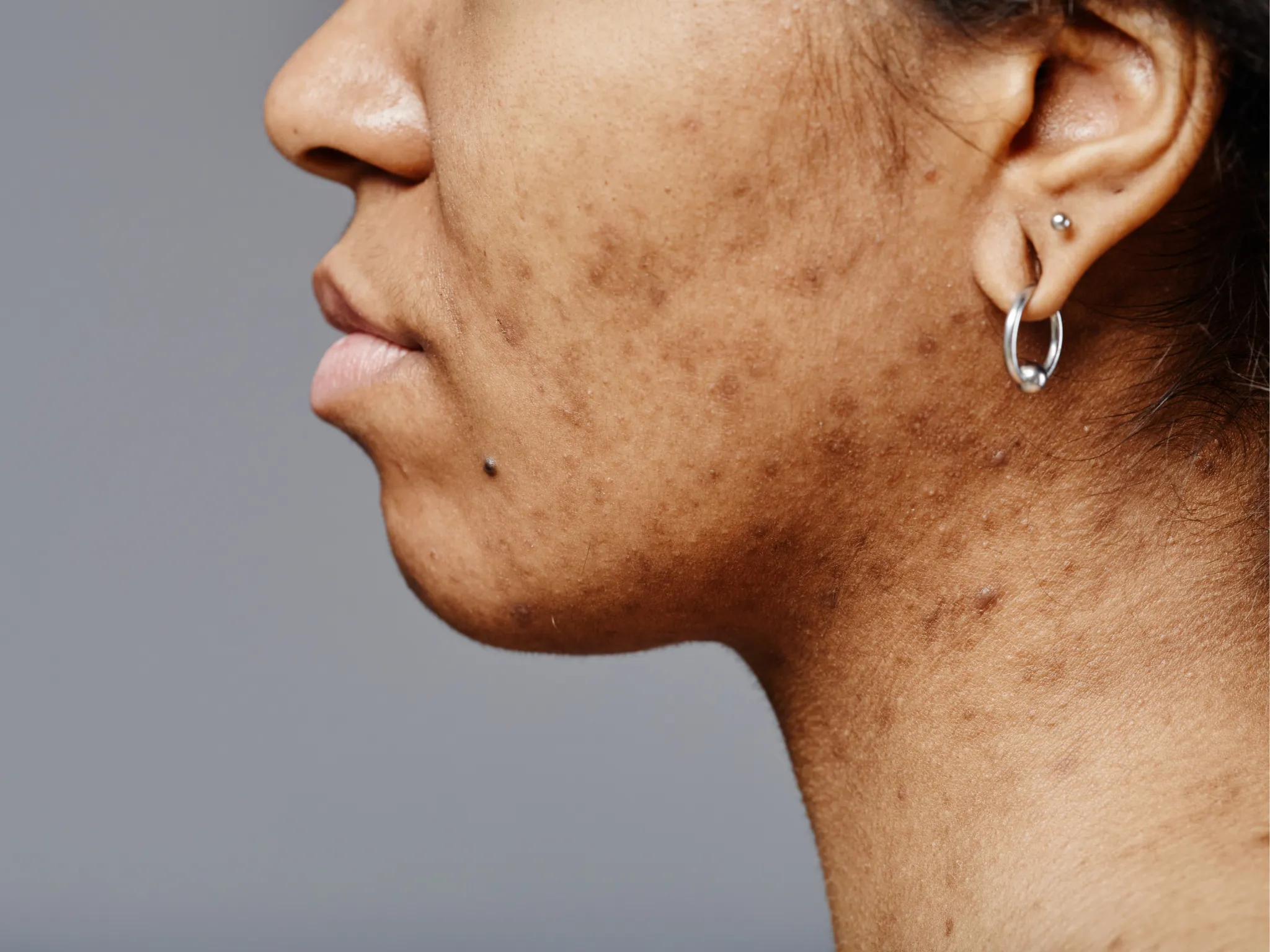 2. Bekas Jerawat yang Susah Hilang_