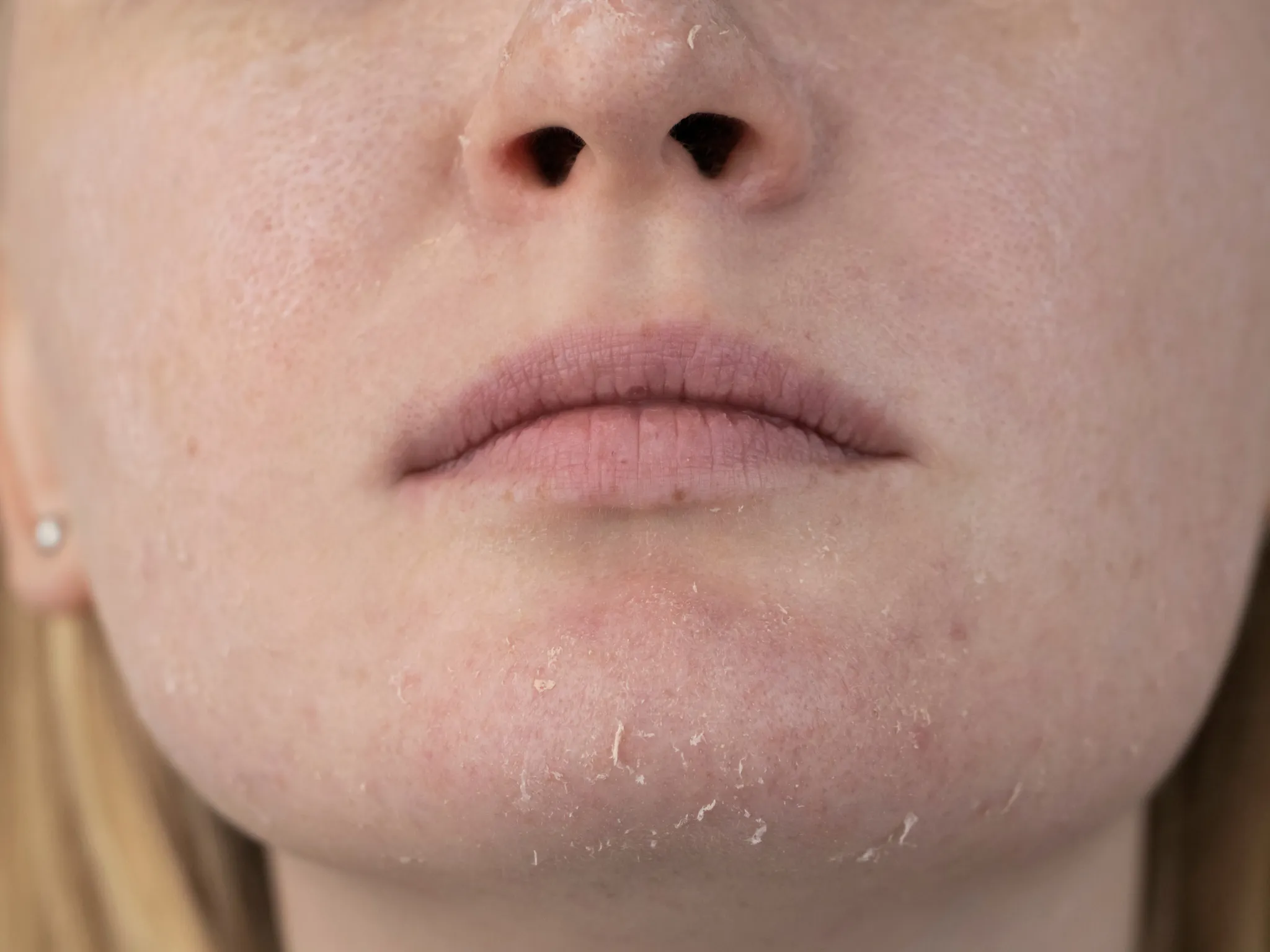 2. Tekstur Kulit Kasar dan Tidak Merata_2. Tekstur Kulit Kasar dan Tidak Merata_