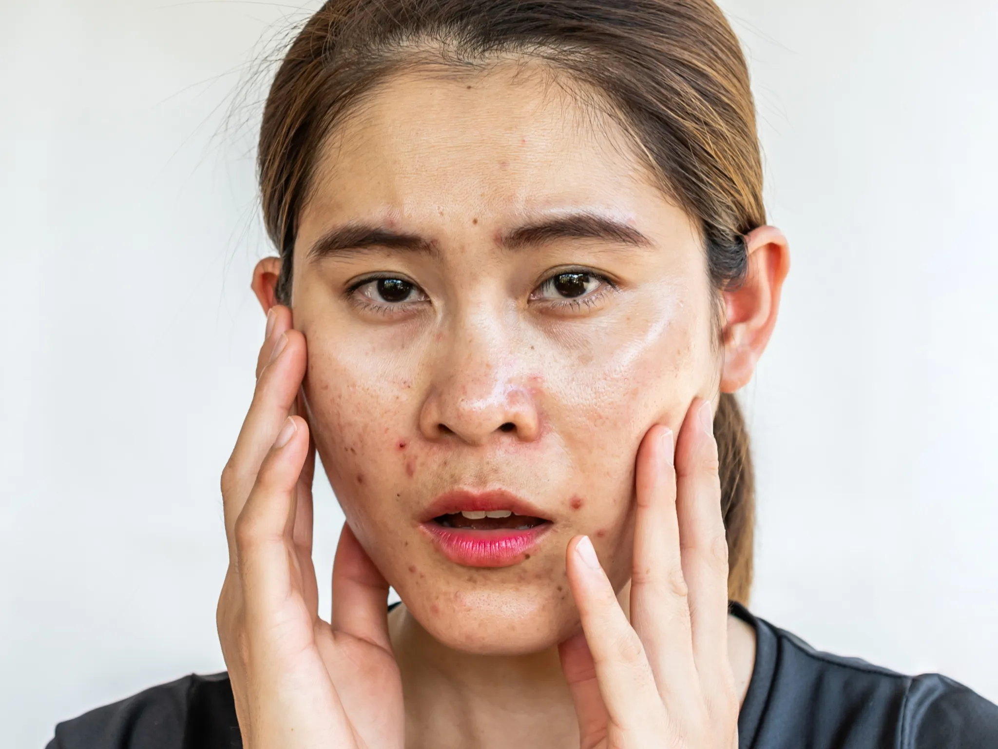 4. Minyak Berlebih dan Pori-Pori Membesar_