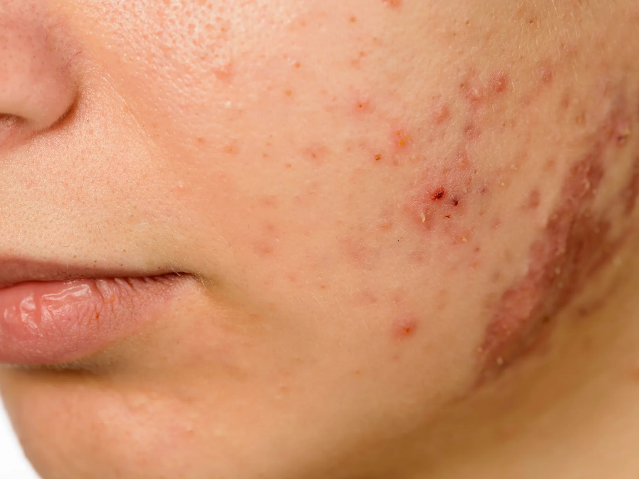 4. Munculnya Luka dan Cekungan Kulit (Scar)_