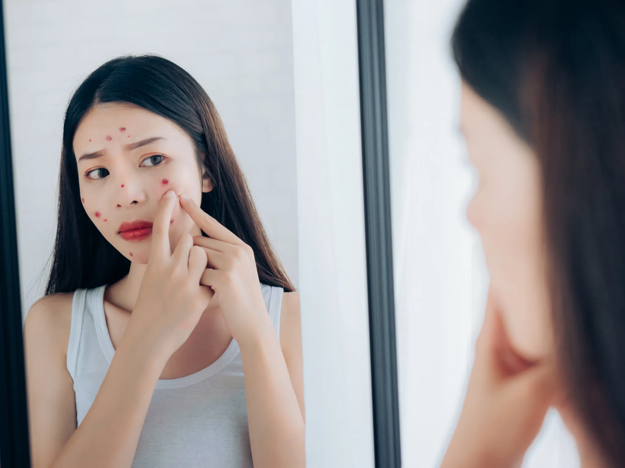 5. Jerawat Cenderung Datang Lagi di Tempat yang Sama_