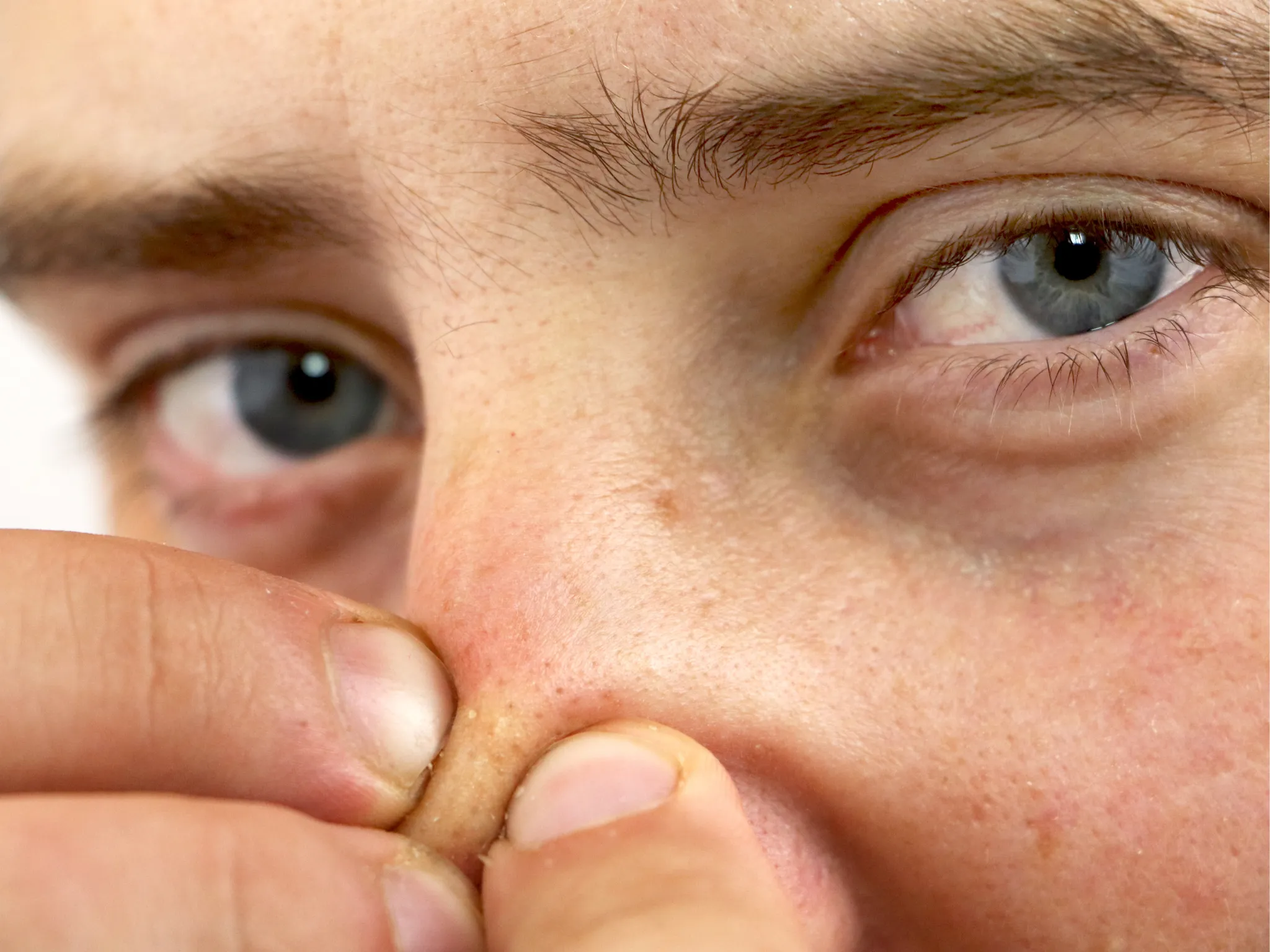 5. Muncul Bintik-Bintik Kecil (Komedo)_