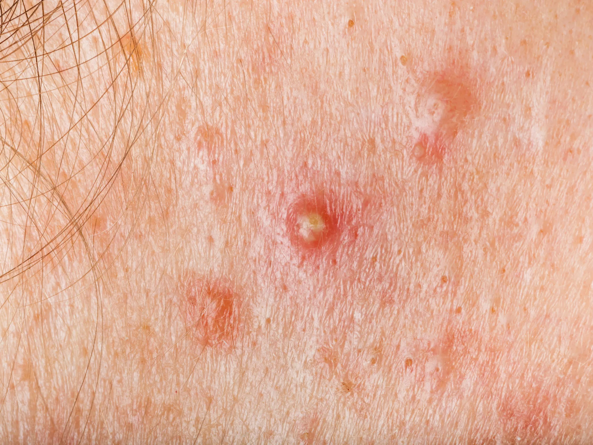 6. Ada Jerawat yang Nggak Sembuh-Sembuh_