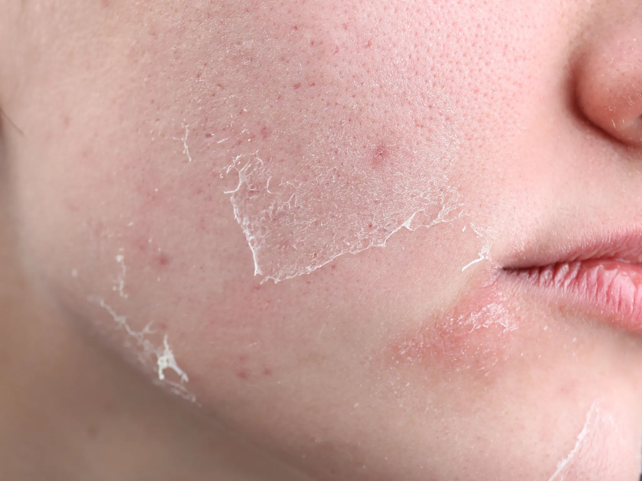 6. Kemerahan dan Mudah Iritasi_