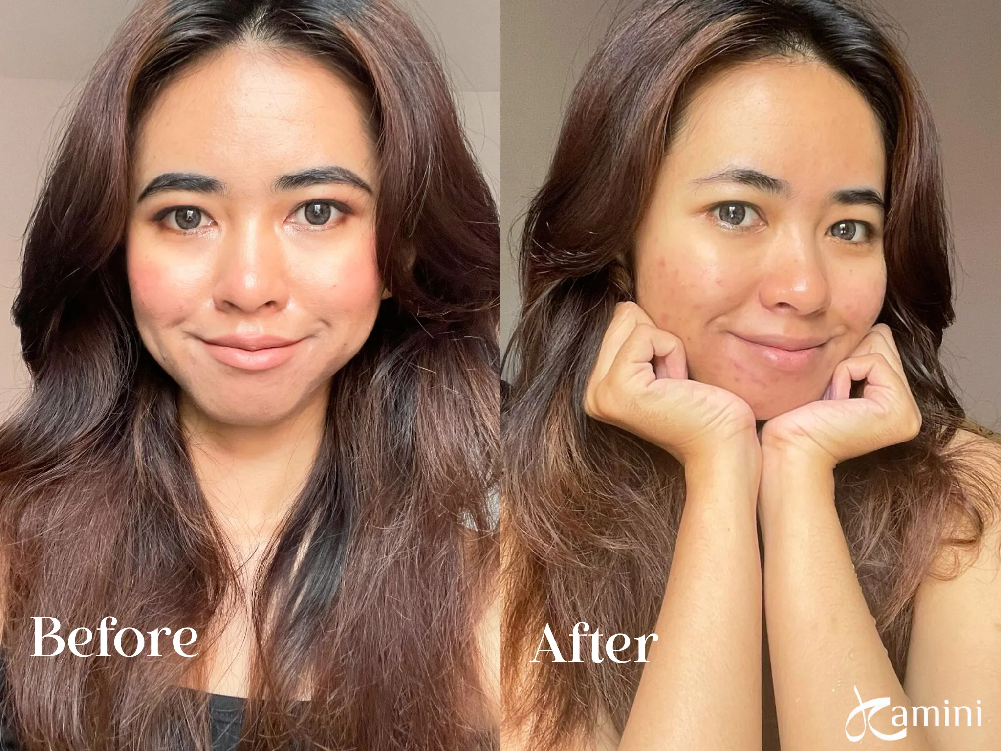 Reaksi di Acne-Prone dan Sensitive Skin