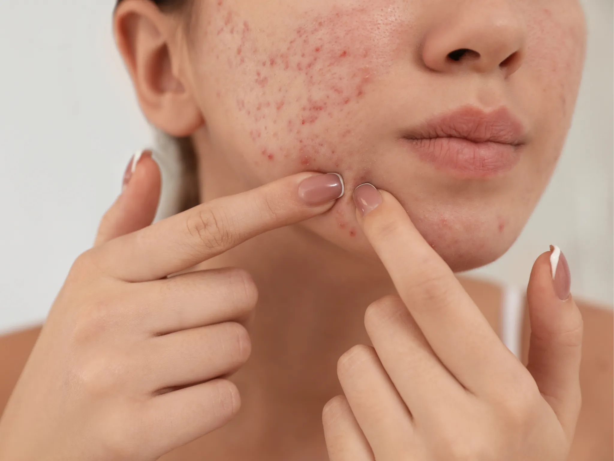 Skin Barrier Rusak Seperti Apa_