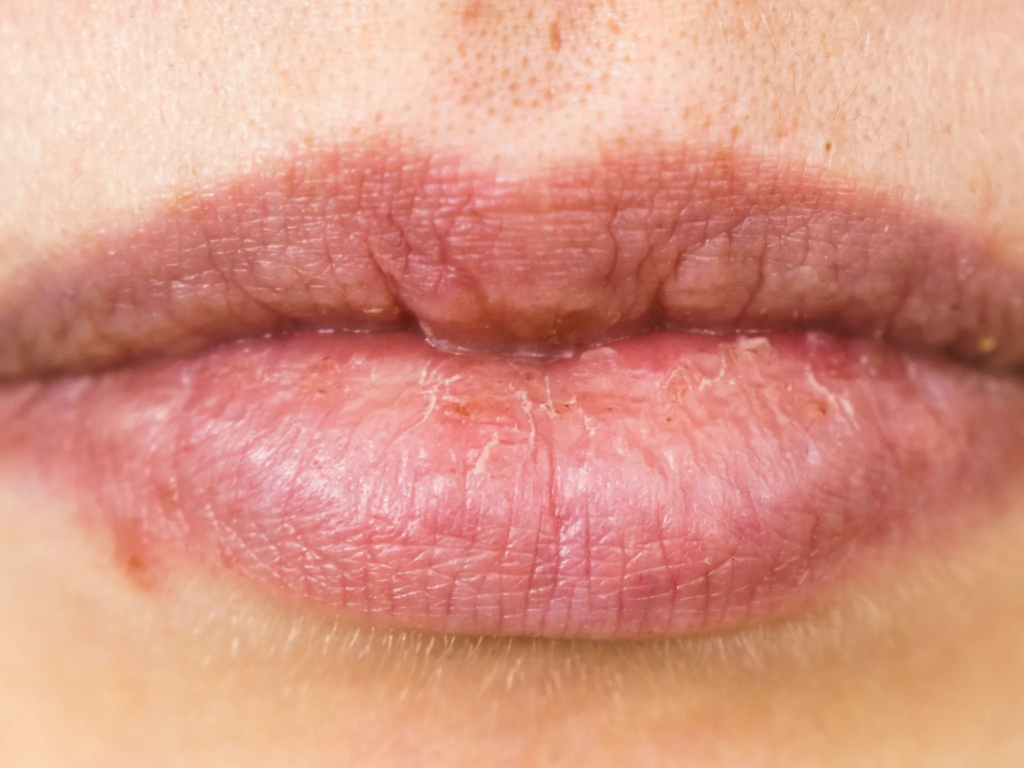 2. Mengatasi Bibir Pecah-Pecah_