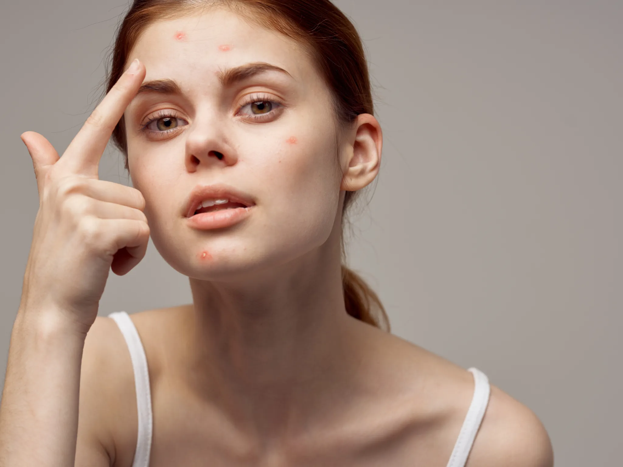 3. Mengatasi Jerawat dan Bekasnya_