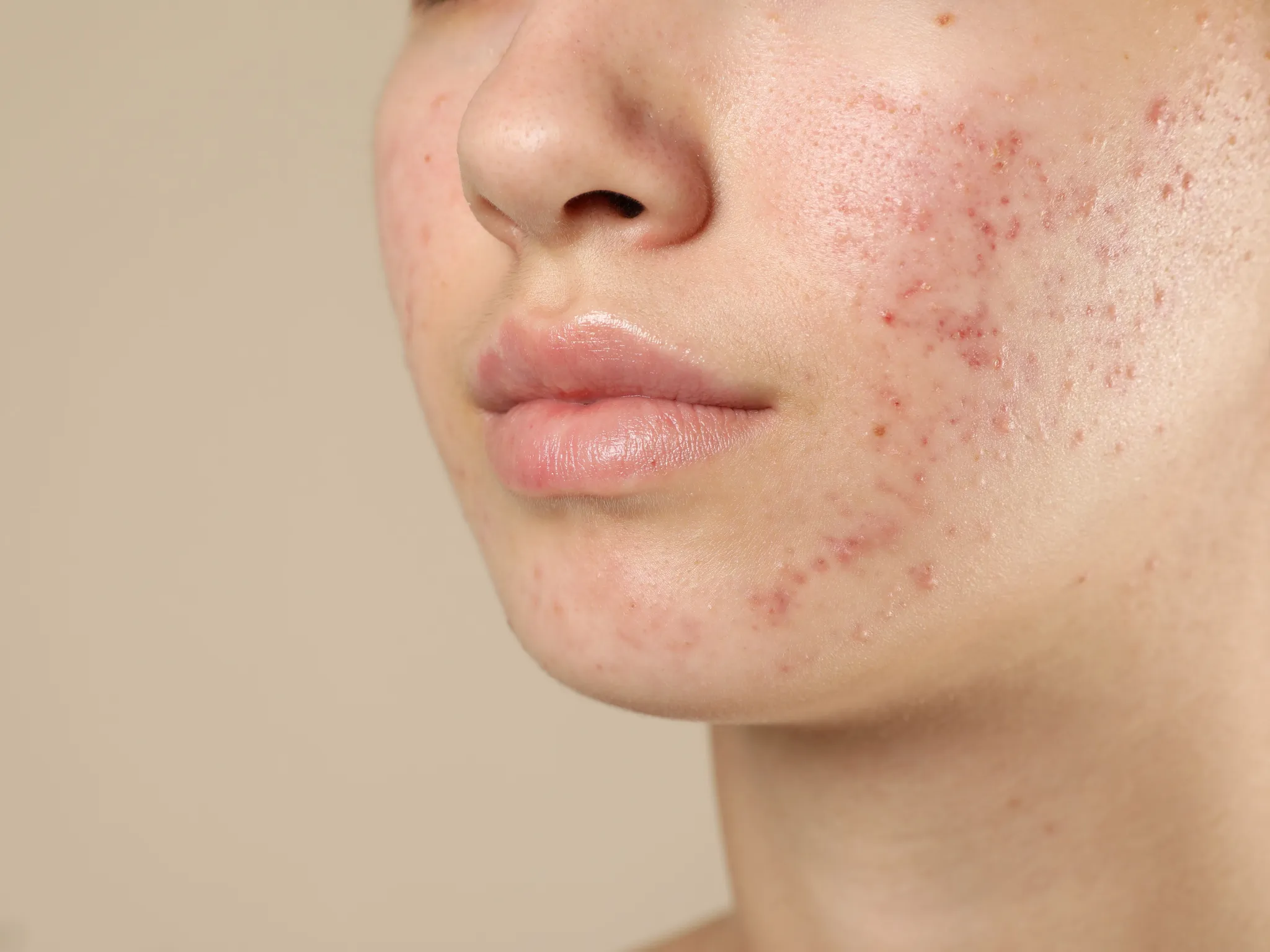 8. Memudarkan Bekas Jerawat_