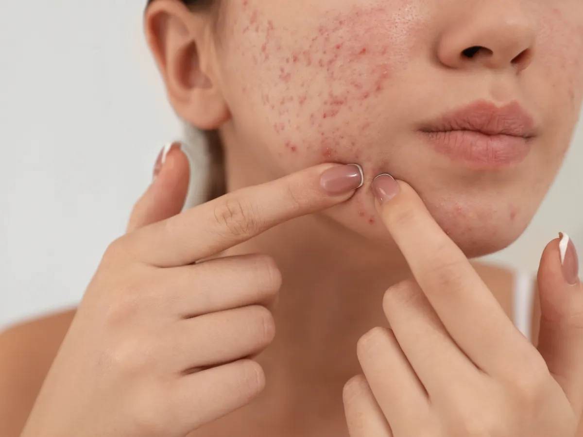 1. Jangan Memencet Jerawat_