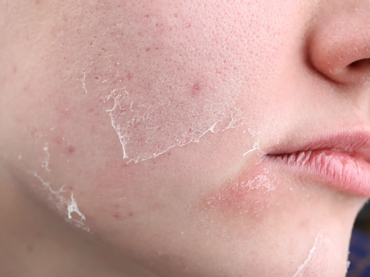 4. Kulit Kering dan Mengelupas_