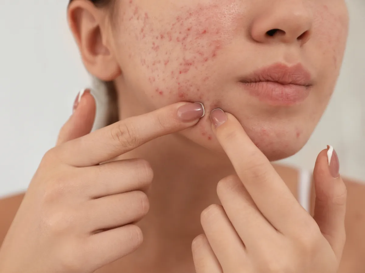 4. Mengatasi Jerawat dan Peradangan_