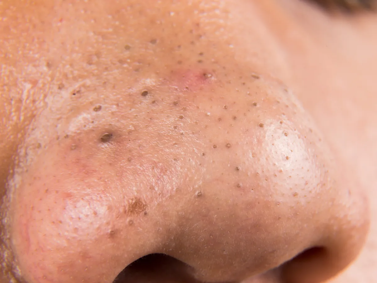 7. Pori-Pori Tersumbat_